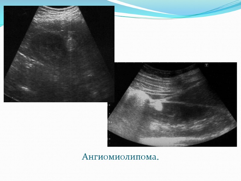 Ангиомиолипома.